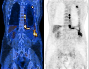 Positron emission tomography scan prior chemotherapy, demonstrating a dispersed hypermetabolic thickening through the left pleura, especially the costodiaphragmatic region, invading the chest wall, and an homolateral pleural effusion with heterogeneous uptake of F-18 fluorodeoxyglucose (SUVmax 10.6).