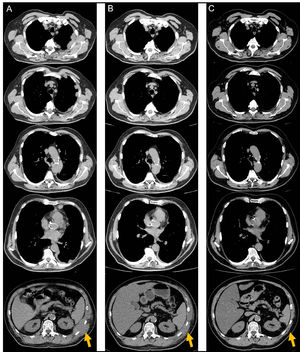 Serial reassessments by computed tomography scan documenting the lesions’ extension and evolution. (A) After 6 treatment cycles of carboplatin-pemetrexed chemotherapy, reflecting recurrence of disease in the left hemithorax. (B) After 4 treatment cycles of nivolumab, demonstrating parcial but impressive response. (C) After 37 treatment cycles of nivolumab with no evidence of recurrence and maintaining remarkable tumour response.