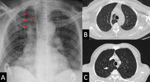 Chest frontal view radiograph (A) demonstrating the hyperdense lateral borders (arrowheads) of the azygos lobe (AL). Radiographs were taken with a 32kW Mobile X-ray unit (70 kVp, 320 mA, 0.5 sec). Superior (B) and inferior (C) axial CT images identifying the azygos vein (B) which separate the azygos lobe from the superior lobe. CT imaging was high resolution CT (HRCT) (slice thickness: 1 mm, scan time: 1 sec, 120 kV, 100 mA). The white arrow (C) shows the boundary of the lobe which is separated by 2 layers of visceral and pleura.