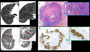 Axial chest HRCT images: (A) MinIP image showing a mosaic attenuation pattern suggestive of air trapping (red asterisks in detail image). (B) MIP image showing countless bilateral millimetric pulmonary nodules (red arrows). (C) Haematoxylin-eosin stain of lung wedge resection fragment: a subpleural carcinoid tumour is seen, in the magnified image x10 high power fields (HPF) cells with neuroendocrine features can be seen: spindle-shaped, without mitotic figures or necrosis (blue box). (D) Chromogranin stain (neuroendocrine marker) shows diffuse positivity in nests of neuroendocrine cells (x20 HPF) (green box).