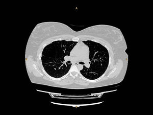 The lung CT scan at the patient