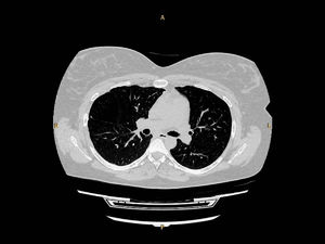 The lung CT scan at the patient's latest consultation (30 months post-partum), showing a diffuse low attenuation area in the right upper lobe.