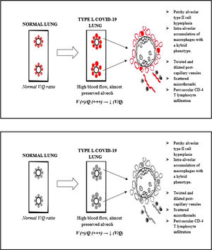 Pathophysiologic considerations about type L COVID-19. This cartoon shows how the histopathological modifications, seen in lung cryobiopsies, may lead to a reduction in the V/Q ratio.