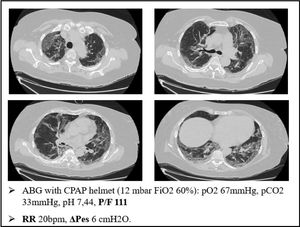 A case of happy hypoxemia. ΔPes shows normal respiratory effort, even if the patient had profound respiratory failure with tachypnea. ΔPes: swings of esophageal pressure during the act of breathing.