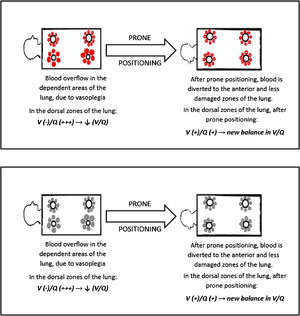 Response to awake spontaneous breathing prone positioning in COVID-19. This cartoon shows that the blood is diverted from the hyperperfused areas of the lung after prone positioning. Amelioration in blood oxygenation might be explained by a new equilibrium in the V/Q ratio.