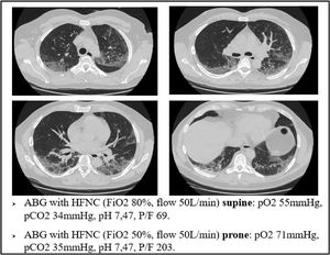 A case of brilliant response to awake, spontaneous breathing, prone positioning.