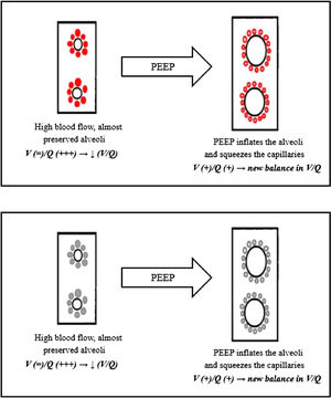 PEEP/CPAP response in type L COVID-19. This cartoon shows how the alveolar inflation provided by the CPAP/PEEP therapy might lead to a new equilibrium in the V/Q ratio.