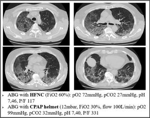 A case of significant response of arterial blood oxygenation in an early COVID-19 case, after initiating CPAP therapy.