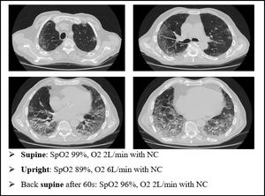 A case of platypnea orthodeoxia occurred during the recovery from a severe case of COVID-19. NC: nasal cannula. platypnea orthodeoxia in type L COVID-19 (HPS like effect).