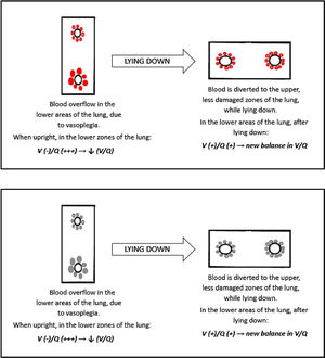 This cartoon shows how blood overflow in the lower areas of the lung might explain the platypnea orthodoxia occasionally seen in COVID-19 patients. This process resembles the one seen in patients affected by HPS. HPS: hepatopulmonary syndrome.