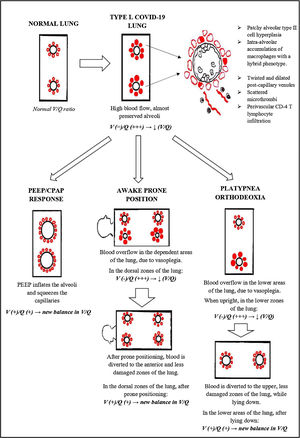 A summary of the pathophysiological phenomena described in Type-L COVID-19.