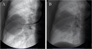 Conventional fluoroscopy-guided transbronchial forceps biopsy (A) and needle aspiration (B) of a right pulmonary mass.
