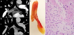 In A, contrast-enhanced CT with coronal reconstruction revealed a soft-tissue mass obliterating the intermedius bronchi (asterisk). In B, follow-up unenhanced CT examination performed 1 day later showed the complete disappearance of the mass (asterisk). In C, the polypoid lesion (mucous plug) eliminated by the patient. In D, histological section of the specimen eliminated demonstrating that the plug contains fibrin, neutrophils, and cellular rests with no tissular organization (hematoxylin and eosin staining, x 100).