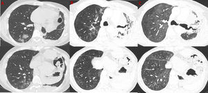 CT axial slices during the evolution of the case. (A first column) CT image from the first diagnosis of SARS-CoV-2 infection 8 months before showing ground glass opacities in the right lower lobe. (B middle column) CT image two months later, before the chemotherapy started, showing ground glass opacities in distinct lung fields. (C third column) CT image revealing persistent ground glass opacities with greater extension on patient's presentation to emergency care.