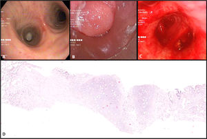 An example of an endobronchial hamartoma totally occluding the intermediate bronchus (Fig. 2. A, B); and later, after treatment by rigid bronchoscopy - mechanical debridement and laser (Fig. 2. C). Endobronchial hamartoma biopsy showing endobronchial epithelium, adipose tissue and hyaline cartilage [H&E; x10] (Fig. 1.D).