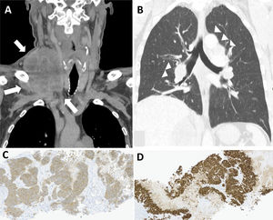 Cervical (A) CT scan revealed a voluminous heterogeneous right laterocervical mass, involving the ipsilateral internal jugular vein (white arrows). Thoracic (B) CT scan revealing multiple mediastinal and hilar nodes (white arrowheads) with no pulmonary findings. Immunohistochemistry from biopsy of the right supraclavicular mass whose pathology result was compatible with a large cell neuroendocrine carcinoma of the lung: positivity for neuroendocrine markers, including synaptophysin (C) and for thyroid transcription factor-1 (TTF-1) (D).