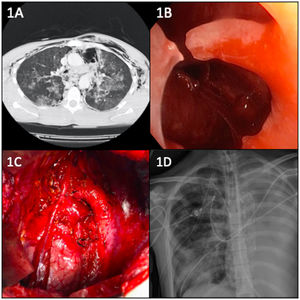 (A) Chest CT image: Subcutaneous emphysema. Pneumomediastinum. Diffuse bilateral pulmonary contusion. Reduction in caliber and loss of mural definition of the left main bronchus. (B) Endoscopic image: Complete amputation of the LMB with visualization of the left pleural cavity through it. (C) Intraoperative image: Extrapericardial left pneumonectomy after ligation of the ductus arteriosus and preservation of the phrenic nerve. (D) Postoperative chest X-ray. Valiant-type prosthesis is observed in the thoracic aorta distal to the left subclavian artery.
