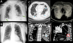 (A) Chest X-ray performed at the Emergency room showing a bibasal alveolointerstitial pattern (green arrows). (B) Previous X-ray without those findings. (C) CT pulmonary angiogram in axial (up and left), coronal (down left), and sagittal (down right) planes with a 3D-VR reconstruction of the airway (up and right), showing confluent and markedly hyperdense condensations of bibasal predominance (asterisks) because of metastatic calcification.