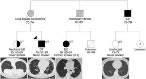 A simplified pedigree depicting a family in which two relatives were screened: one was diagnosed with preclinical ILD while the other was unaffected at the time of examination. Males and females are depicted by squares and circles (respectively); the proband is indicated by the black triangle; deceased individuals are indicated by a diagonal slash and the age range at death is indicated below followed by a ¿; grey shading indicates that the clinical diagnosis was reported by the living generation; black shading indicates participants confirmed to have IPF/ILD and participants diagnosed with preclinical ILD are indicated by half black shading; age range at examination for the unaffected relative is indicated below unshaded symbol; ‘Dx’ indicates age range at diagnosis; two living, unscreened female relatives are currently 64-69 years of age; self-reported smoking status is indicated and pack years is presented in brackets; MUC5B rs35705950 genotype is presented at the top right, G/T indicates a heterozygous carrier and G/G indicates homozygous wildtype; representative chest HRCT images are presented below study participants.