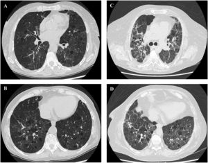 HRTC images showing bilateral pulmonary cysts in a hypersensitivity pneumonitis patient at diagnosis (A,B) and after a 10 year follow-up (C,D).