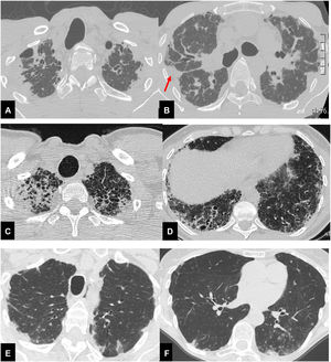 Thirty-seven year-old male (A,B), with surgical biopsy-proven PPFE and severe impairment of PFT (FVC 27% FEV1 25% DLCO 31%). CT scan shows bilateral, dense pleural and subpleural fibrosis suggestive of PPFE, in the upper and mid lung regions. The elastotic tissue is also present in the fissures, with particular evidence for the right one (red arrow). Scattered traction bronchiectasis are present in the surrounding dense elastotic fibrosis. Sixty-seven year-old female (C,D), with diagnosis of familial pulmonary fibrosis. Surgical lung biopsy documented: PPFE + UIP pattern. CT scan shows brobable UIP pattern in both lower lobes, mainly on the right associated with pulmonary ossifications e traction bronchiectasis. Seventy-eight-year-old female (E,F), affected by Sjogren disease, with diagnosis of bronchiolitis Nocardia abscessus related. PPFE is present in both upper lobes associated with centrilobular nodules and mucus plugging in the bronchi in the left lower lobe.