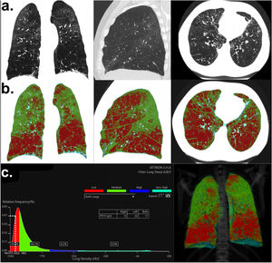 a. High-resolution chest computed tomography of the proband. Normal lung parenchyma distortion due to emphysema. Frontal, sagittal and axial views (from left to right), b: Color-coded visual map on lung density analysis to assess lung emphysema. Red-colored pixels represent attenuation lower than <-950HU, c: Lung density distribution graph. PD15 = -983HU shows an estimated pulmonary density of 17 g/L (for both lungs). The percentage of emphysema (areas of low-attenuation) was estimated ∼ 44,2% for both lungs.