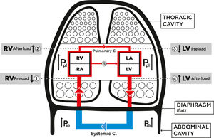 Schematic diagram showing the mechanical effects of lung hyperinflation on the cardiovascular system (CVS). Hyperinflation increases intra thoracic pressure (Pleural pressure (Ppl)), the pressure on the parts of the CVS inside the thoracic cavity, increases abdominal pressure (Pab) and flattens the diaphragm. 1. RV Preload reduced: decreased venous blood return due to venous compression {Ppl +Pab+ flat diaphragm) and increase RA pressure. 2. RV Afterload increased: increased RV end-diastolic and pleural pressures, and increased resistance of pulmonary circulation. 3. LV Preload reduced: decreased filling pressure and compliance of LV plus cardiac fossa