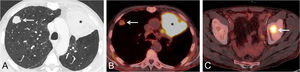 (A) Axial thoracic contrast-enhanced CT image (lung window) shows a large left upper lobe mass (asterisk) and a smaller right upper lobe nodule (arrow). (B) Axial fused PET/CT image demonstrates intense FDG uptake by the left upper lobe mass (asterisk) but mild FDG avidity by the right upper lobe nodule (arrow), suggesting two synchronous primary lung tumors. (C) Axial fused PET/TC image shows an FDG-avid bone lesion involving the left acetabulum (arrow).
