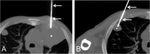 “Double” lung biopsy performed during one single session. (A) Axial thoracic MIP (maximum intensity projection) CT image (lung window) shows the needle (arrows) targeting the left upper lobe mass (asterisk). (B) Axial thoracic MIP CT image shows the needle (arrows) targeting the right upper lobe nodule (asterisk).