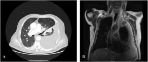 Computed tomography (CT) scan (A), Chest MRI (B). Mediastinal pleural mass associated with extensive pleural effusion on the left.