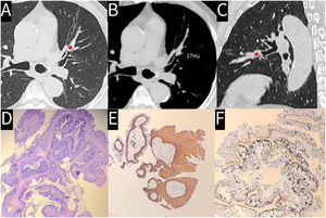 (A) Axial computed tomography (CT) with lung window showing an endobronchial mass in the left lingular segmental bronchus (asterisk). (B) CT value measurement of the endobronchial mass. (C) Sagittal CT with lung window showing the endobronchial mass (asterisk). (D) Hematoxylin and eosin-stained image showing branched fibrovascular cores in the center of tumor papilla lined by squamous and glandular epithelium. (E) Immunohistochemical staining showing CK5/6 expression in squamous and basal cells. (F) Immunohistochemical staining showing P63 expression in basal cells.