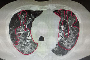 Multiple ground-glass areas (red line) with peri-bronchial distribution.