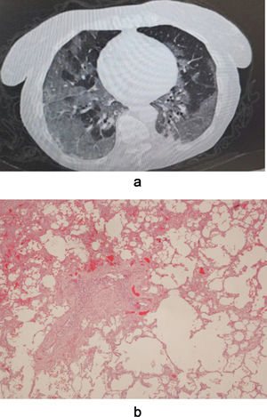 A. Bilateral ground glass opacities in subpleural position and little consolidations in both lower lobes. B. An optical microscopical vision of layer histology of the lung showing diffuse vascular congestion, fibrotic replacement of lung parenchyma and emphysema. Diffuse alveolar damage with hyaline membranes is also present.