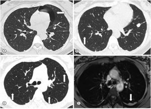 In (A), axial CT scan demonstrates pulmonary cysts and a pneumothorax (white arrow) during the follicular phase of the menstrual cycle. In (B) and (C), axial reconstructions of CT scans demonstrate small, regular and thin-walled cysts in both lungs (white arrows). In (D), chest MRI shows slight bilateral posterior pleural thickening, with an intermediate signal on T2, that may correspond to blood content (white arrow). Legend: CT: computed tomography; MRI: magnetic resonance imaging.