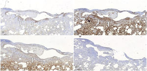 Right lung segmentectomy demonstrating endometrioid-type stroma cells around subpleural areas of cystic appearance stained positively for the estrogen receptors (A), CD10 (B), and WT1 (C) (white arrows) and negatively for HMB45 (D), that confirmed the hypothesis of thoracic endometriosis. Legend: HMB45: melanoma marker antibody; WT1: Wilm's tumor 1 gene.