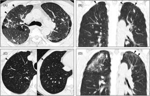 Low-dose chest CT images of four artificial stone manufacturing workers reveal subpleural curvilinear lines (black arrowhead) in the upper lung and other imaging features associated with silicosis. (A) Subject 1 exhibits scattered lung nodules (white arrow) and a large opacity in the right upper lung. (B) Subject 2 displays centrilobular nodules (white arrow). (C) Subject 3 presents ground-glass opacities and centrilobular nodules. (D) Subject 4 demonstrates scattered lung nodules (white arrow), ground-glass opacities, and a large opacity in the right upper lung.