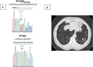 (A) Segment of SERPINA1 showing Pi*Q0Santana (NM_000295.5:c.905del:p.Asn302MetfsTer22) mutation in index case and wildtype allele (Pi*M1). (B) The presence of bronchiectasis and emphysema, predominantly at the bases, in index case.