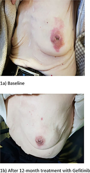 Photographic registries of the evolution of the breast lesion.