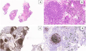 Lymph node tissue in the cryosample (H&E,low power) (a). A “burn-out” or regressed germinal center with a penetrating vessel with thicked wall and high endothelial cells (“lollipop” appearance) (H&E, high power) (b). Numerous germinal centers are highlighted by anti-CD20 monoclonal antibodies (CD20, low power) (c). Large dysplastic cells inside the germinal center marked by CD23 antibody (dendritic intrafollicular cells) (CD23, medium power) (d).