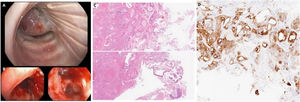 A. Endobronchial mass determining stenosis > 90%; B. Endoscopic image after laser-therapy; C. H&E, 400x Histologic sections on biopsy specimen shows follicular and solid growth of eosinophilic tumor cells, with large and granular cytoplasm, consistent with oncocytic neoplasm (immunostaining not shown); D. 400x Immunohistochemical staining for Thyroglobulin showing expression in follicular structure of tumor cells.