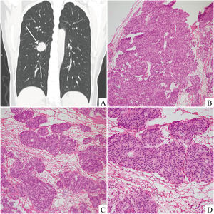 Thoracic CT (A) scan displayed a single, well-circumscribed, solid, regular mass in the lower lobe of the right lung (white arrow). On intraoperative consultation, it was showed that the tumor cells were mainly in solid growth pattern (B, ×100). In these area, the distinct rosette structures similar to carcinoid were observed (C, ×100) (D, ×200).