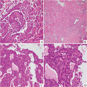 The classical papillary growth pattern of SP with surface cuboidal cells and stromal round or polygonal cells were found in the permanent sections (A, ×100). The sclerotic (B, ×100) and rosette-shaped (C, ×200) growth pattern were also observed. The tumor cells in these rosette areas were relatively uniform without obvious atypia (D, ×400).