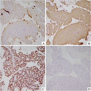In this rosette structure region, surface cells were immunopositive for AE1/AE3 (A, ×200), and all tumor cells were immunopositive for Vimentin (B, ×200) and TTF-1 (C, ×200). But all tumor cells were immunonegative for INSM1 (D, ×200) .
