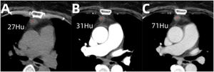 Plain CT image (A), arterial phase enhanced CT image (B), venous phase enhanced CT image (C) showing the mass with obvious enhancement in the venous phase.