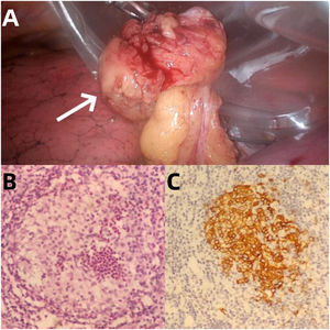 Surgically removed tissue (arrow, A). Hematoxylin and eosin-stained images showed tumor cell nuclei of renal or coffee bean shape with complex folded nuclear membranes and obvious nucleoli, accompanied by a large number of eosinophilic infiltration(B). Immunohistochemical staining showed that Langerhans
