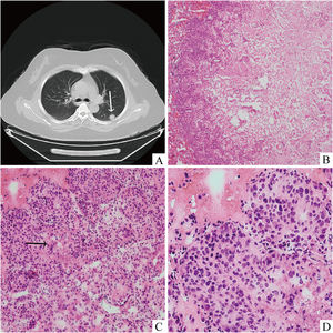 Thoracic CT (A) scan displayed an irregular mass with superficial lobulation and burr sign located at the dorsal segment of the left lung lower lobe (white arrow). (B) Intraoperative consultaion revealed that the centre of the nodule was hypocellular and the peripheral areas consisted of abundant tumour cells (Hematoxylin and eosin stain, 40 ×). Epithelioid tumour cells with nuclear deviation were arranged in solid sheets with (C) necrosis (Hematoxylin and eosin stain, 200 ×) (black arrow) and (D) marked atypia (Hematoxylin and eosin stain, 400 ×).