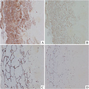 Tumour cells were diffuse positive for CD34 (A, × 200) and ERG (B, × 200). However, all tumour cells were negative for AE1/AE3 (C, × 200) and TTF-1 (D, × 200).