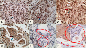 hTERT immunostaining, ×400 magnification. In each case the blue arrow indicates the nucleus and the red arrow indicates the cytoplasm A. High nuclear and very low cytoplasmic expression in a case of LC without fibrosis. B. High nuclear and moderate cytoplasmic expression in a case of LC without fibrosis C. High nuclear and moderate cytoplasmic expression in a case of IPF-LC. D. Low nuclear and high cytoplasmic expression in case of LC without fibrosis. E and F. hTERT immunostaining, x200 magnification. Healthy adjacent tissues of cases C and D with negative expression of hTERT in pneumonocytes (indicated in circled areas). Abbreviations: IPF: Idiopathic Pulmonary Fibrosis; LC: Lung Cancer; hTERT: human telomerase reverse transcriptase.