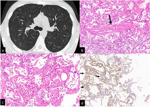 CT scan without contrast. Multiple ill-defined ground glass centrilobular nodules distributed to both lungs. No mosaic attenuation related to air trapping is visible (a). Transbronchial cryiobiopsy:an interlobular vein with the lumen partially obstructed by fibrous tissue (b, arrow). Interstitial thickening is due to hyperplastic/dilated capillary-like vessels (arranged in superimposed rows). Hemosiderin-laden macrophages in the alveolar spaces (c). Alveolar capillaries marked by CD31 monoclonal antibodies are arranged in superimposed rows (d, arrows).