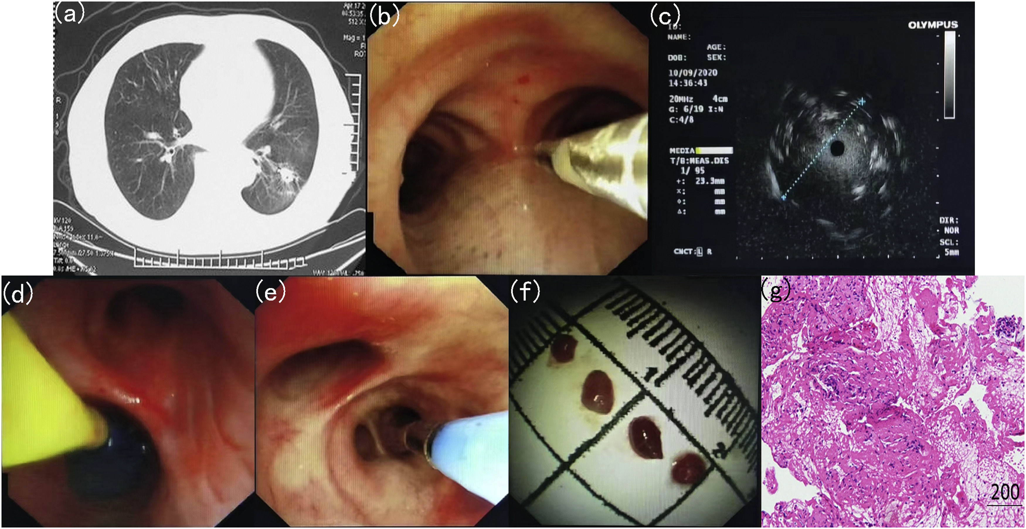 Transbronchial Lung Cryobiopsy For Peripheral Pulmonary Lesions A Narrative Review Pulmonology 1964